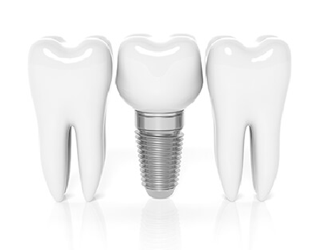tooth implant