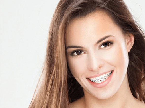 braces