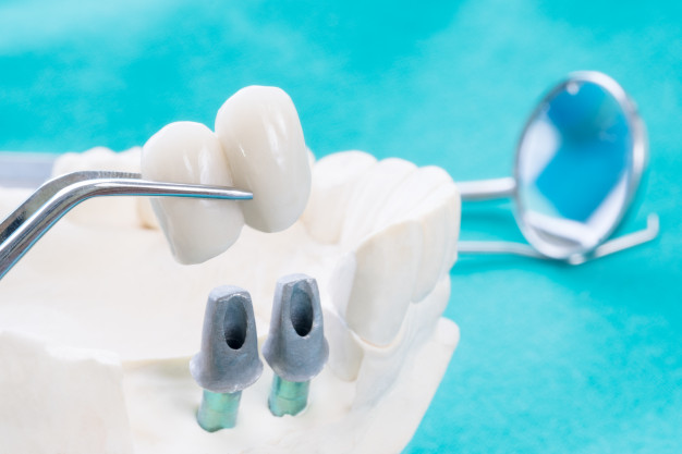 implan model tooth support fix bridge implan crown
