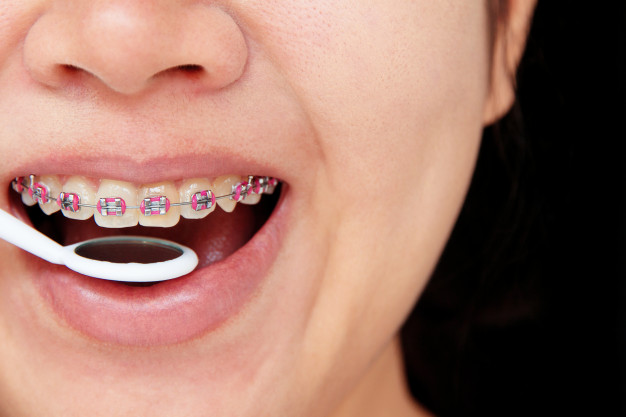 girl smiling with braces teeth