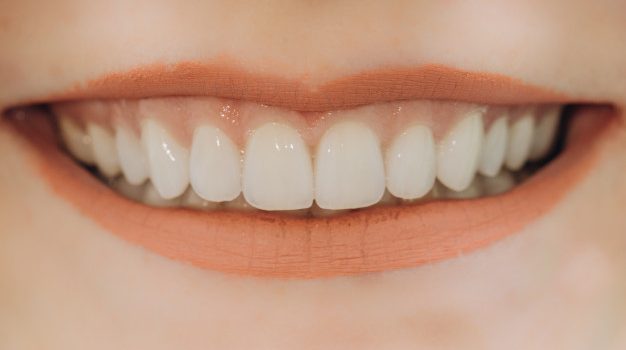 Veneers Lancaster Texas