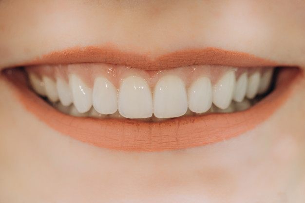 Veneers Lancaster Texas