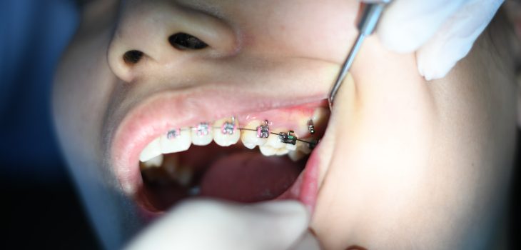 teeth braces
