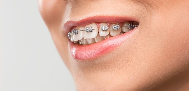 Braces and orthodontic treatment questions and answers