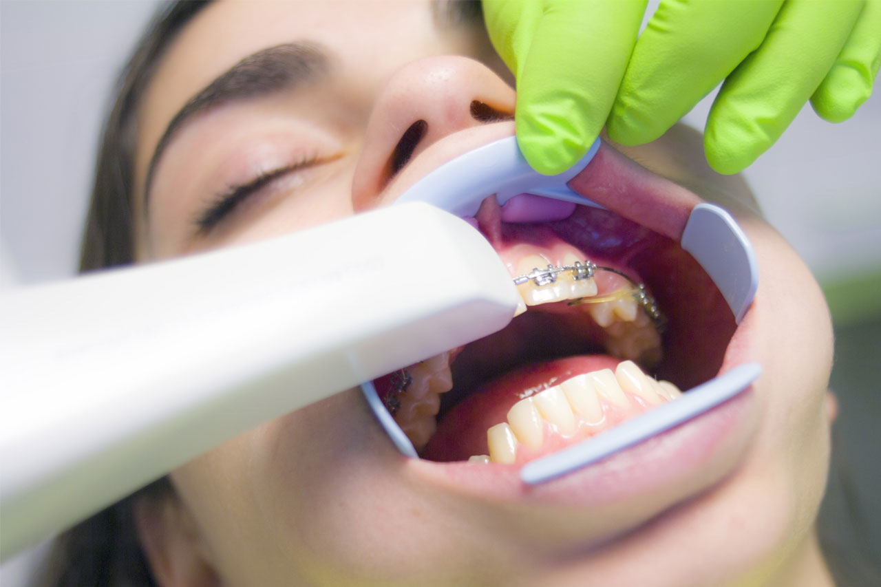 scanning patient teeth with iTero